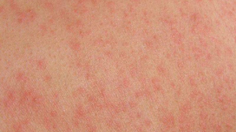 Bạn cần ngưng sử dụng kem chống nắng khi gặp các triệu chứng bất thường như nổi mẩn đỏ Bạn cần ngưng sử dụng kem chống nắng khi gặp các triệu chứng bất thường như nổi mẩn đỏ