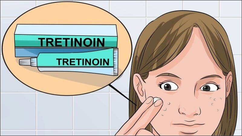 Tretinoin thúc đẩy loại bỏ tế bào chết, giữ lỗ chân lông thông thoáng và giảm dầu thừa, từ đó làm giảm mụn viêm