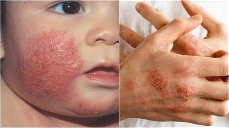 Lá cây bàng có hoạt tính chống viêm và chống oxy hóa, giúp bảo vệ gan và cải thiện tình trạng da