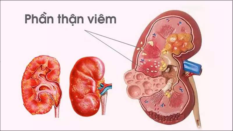 Kết hợp rễ cỏ tranh và một số dược liệu giúp hỗ trợ điều trị viêm thận cấp