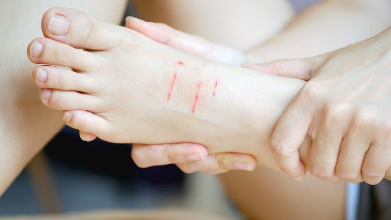 Người bị cắn nên tiêm phòng càng sớm càng tốt