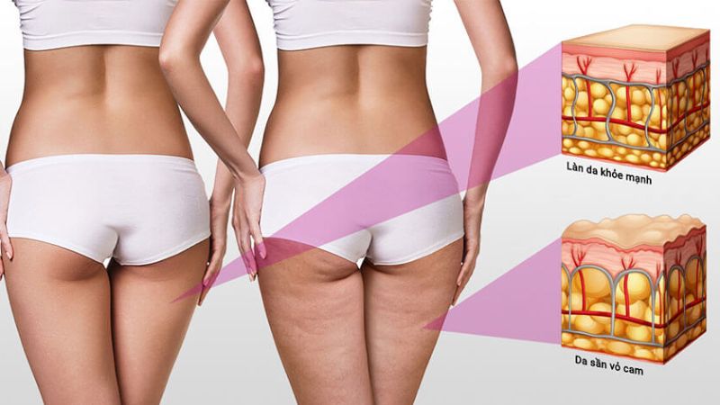 Tiêm meso giúp giảm mỡ, tăng cường trao đổi chất, giúp da mịn màng và săn chắc
