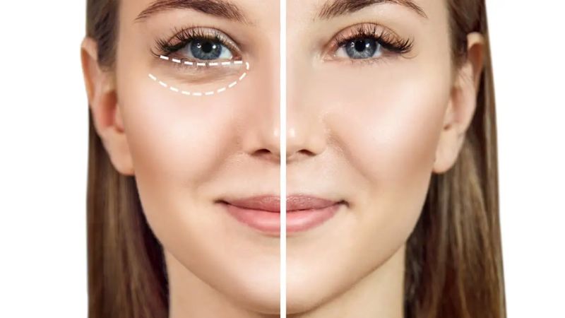 Tiêm meso giúp cải thiện tình trạng quầng thâm mắt đáng kể