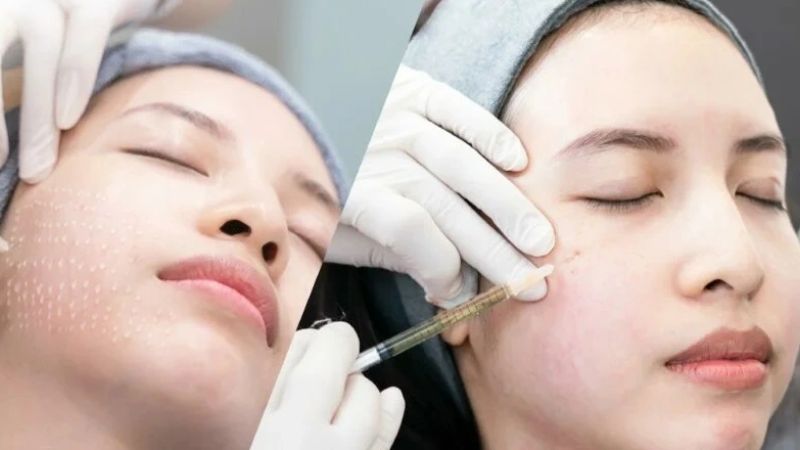 Không dùng kem tẩy trắng trước khi bắt đầu liệu trình từ 1 - 2 ngày
