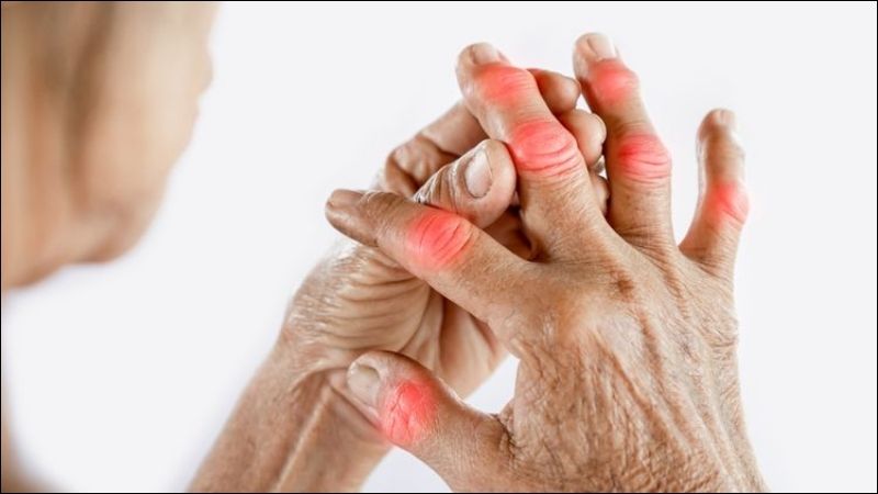 Có thể giảm triệu chứng thấp khớp bằng bài thuốc với lá xương sông