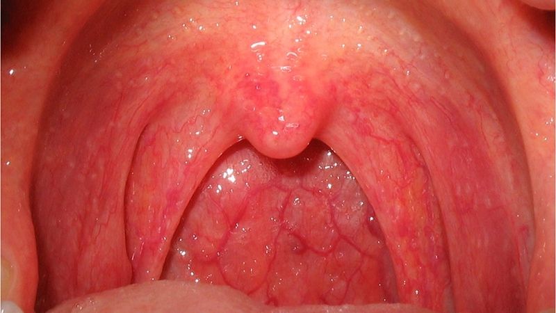 Uống nước thuốc với lá xương sông trong 5 - 7 ngày giúp trị viêm họng