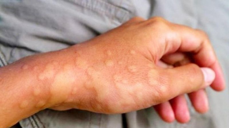 Nấu lá xương sông với thịt heo, chem chép để ăn có thể giúp chống dị ứng