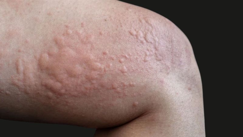 Người bị dị ứng với các thành phần có trong lá cây xương sông thì không nên dùng