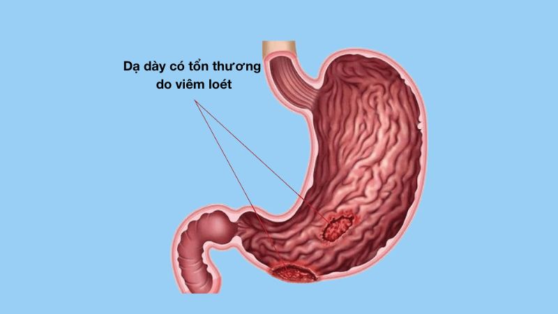 Cây xương sông có thể hỗ trợ điều trị loét dạ dày