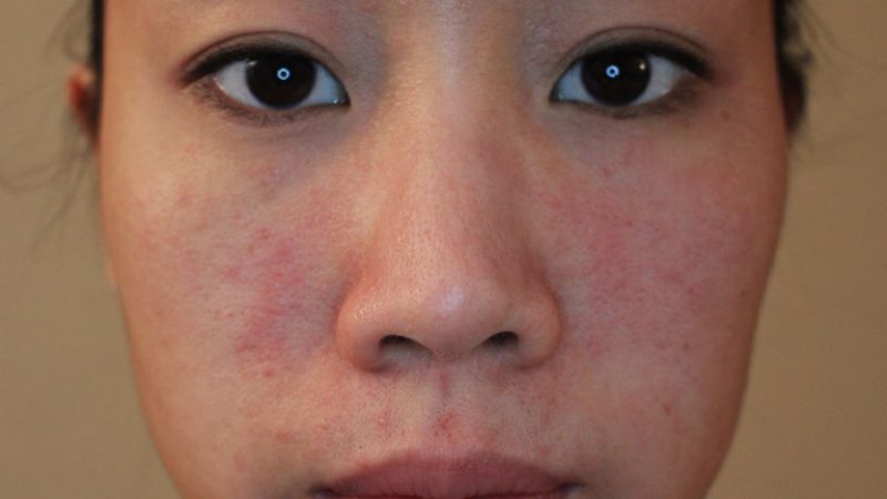 Khi dùng glycerin, người dùng có thể bị kích ứng nhẹ