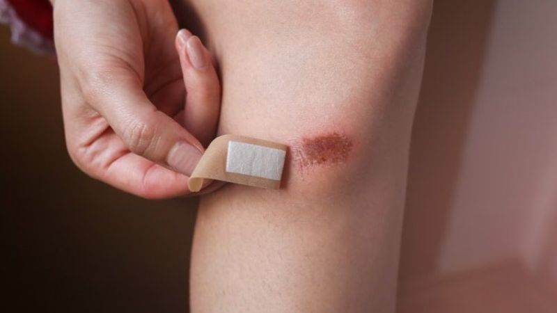 Glycerin có thể hỗ trợ thúc đẩy quá trình chữa lành vết thương
