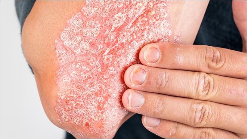 Glycerin giúp điều trị bệnh vảy nến bằng cách dưỡng ẩm và làm mềm da
