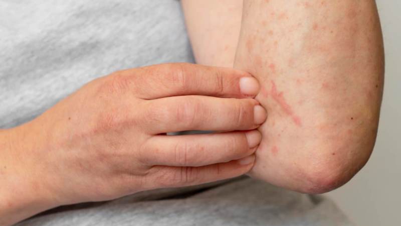 Hôn làm giảm phản ứng nổi mề đay trên da do dị ứng