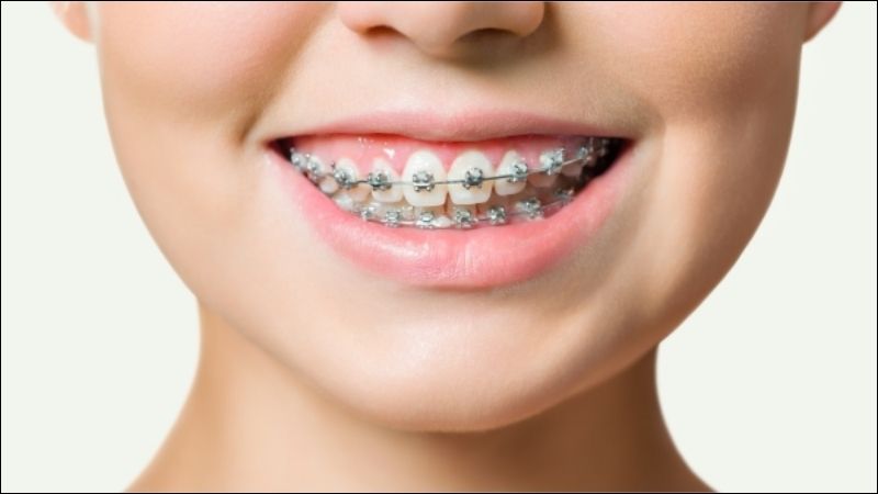 Niềng răng là cách hiệu quả giúp răng trở nên thẳng hàng và hài hòa hơn