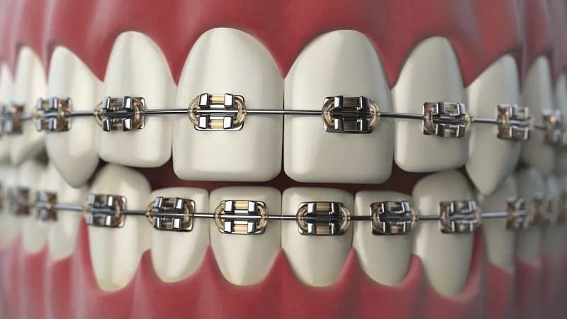 Niềng răng mắc cài kim loại là lựa chọn lý tưởng cho những ai muốn đạt hiệu quả tối ưu với chi phí hợp lý