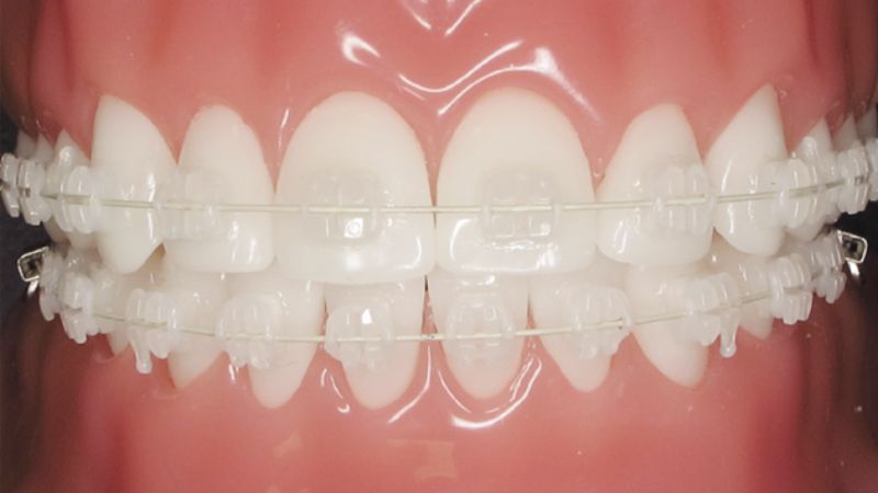 Niềng răng mắc cài sứ được thiết kế tương đồng với màu răng, tăng tính thẩm mỹ