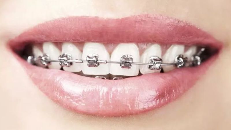 Niềng răng giúp giảm ma sát và hạn chế cảm giác khó chịu
