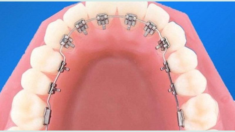 Niềng răng mặt trong có tính thẩm mỹ cao do thiết kế gần như vô hình