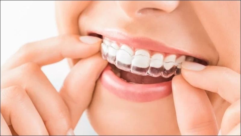 Niềng răng trong suốt có tính thẩm mỹ, linh hoạt nhưng yêu cầu sự tự giác và cẩn thận