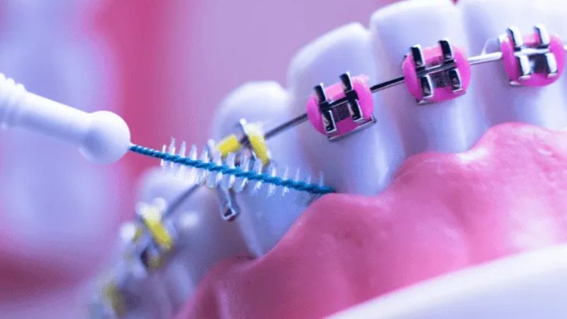 Niềng răng mini dễ vệ sinh và rút ngắn thời gian niềng nhưng vẫn đảm bảo hiệu quả