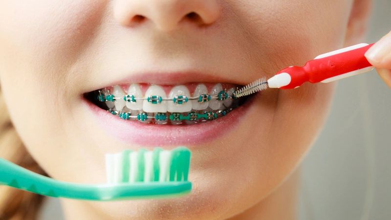 Chăm sóc răng miệng đúng cách khi niềng răng rất quan trọng