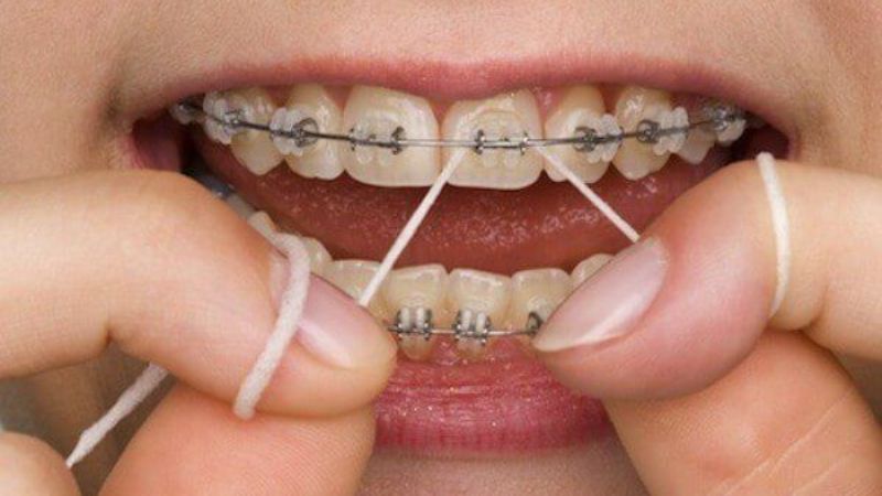 Dùng chỉ nha khoa giúp loại trừ các mảng bám còn trong kẽ răng