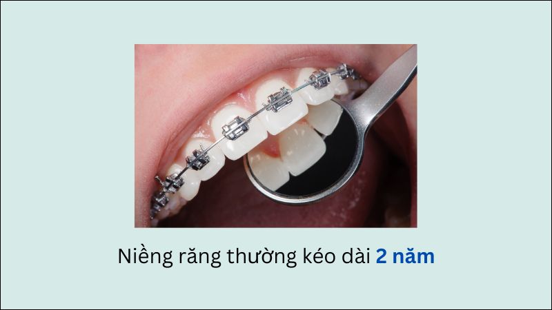 Thông thường, việc niềng răng sẽ diễn ra trong khoảng 2 năm