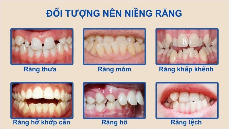 Các đối tượng này cần cân nhắc tìm đến bác sĩ chuyên khoa để niềng răng