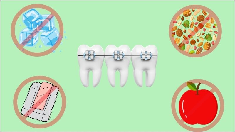Để bảo vệ niềng răng, nên tránh các loại thực phẩm cứng, dai hoặc dẻo dính