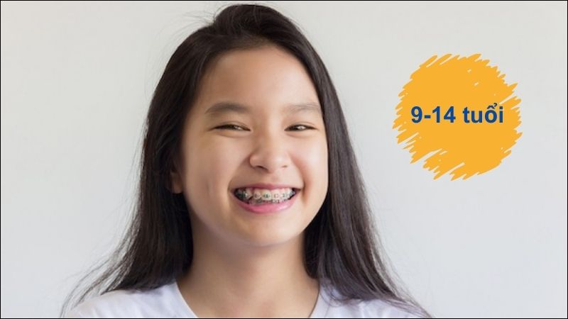 Phần lớn trẻ bắt đầu niềng từ 9-14 tuổi, khi cơ thể đang phát triển