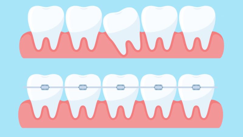 Niềng răng tạo ra lực tác động đều đặn lên răng, giúp chúng di chuyển về vị trí đúng