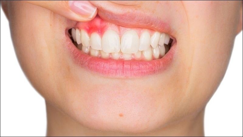 Niềng răng giúp giảm nguy cơ mắc các vấn đề về răng như sâu răng và viêm nướu