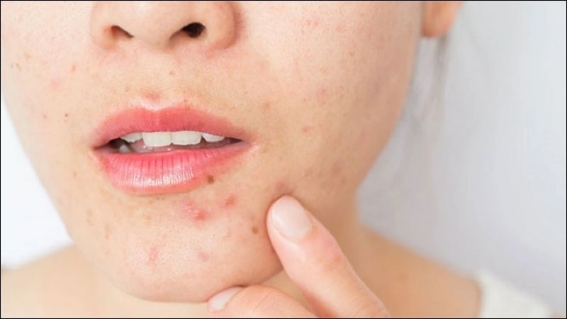 Mặt nạ giúp giảm mụn nhờ khả năng làm sạch sâu và kiểm soát dầu thừa trên da