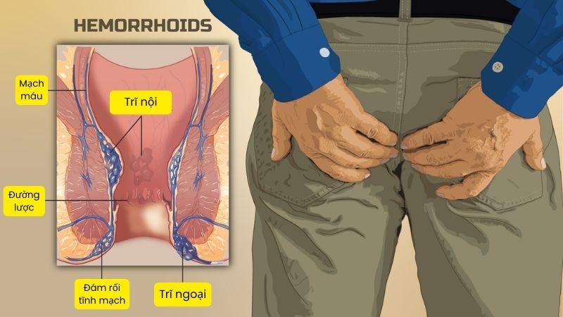 Hoa thiên lý giúp ngừa viêm và tăng tốc độ chữa lành vết thương trong điều trị bệnh trĩ