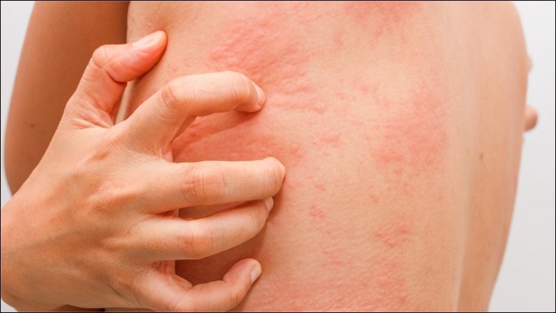 Quả đào có khả năng giảm các triệu chứng dị ứng và viêm nhiễm