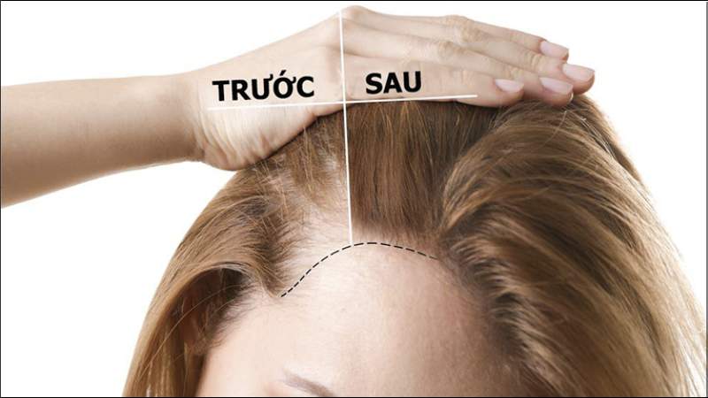Lá xoài bảo vệ các nang tóc khỏi bị hư hại và hỗ trợ sự phát triển của tóc