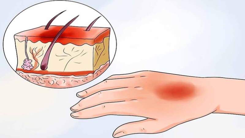Lá xoài giúp làm dịu các vết bỏng nhẹ với diện tích tổn thương nhỏ