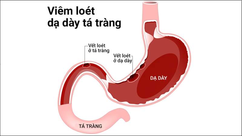 Sử dụng chiết xuất ​​lá xoài làm giảm tình trạng tổn thương dạ dày
