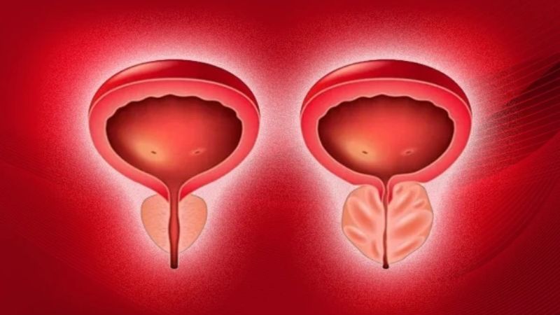 Bán chi liên có tác dụng hỗ trợ điều trị phì đại tuyến tiền liệt