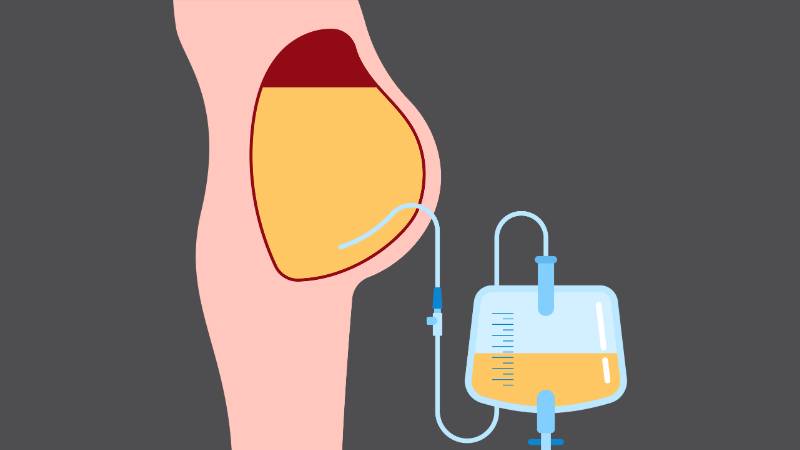 Bài thuốc sử dụng đại hồi giúp hỗ trợ điều trị cổ trướng