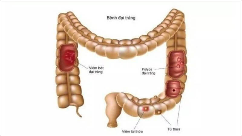 Chiết xuất từ hạt chà là có khả năng bảo vệ đại tràng khỏi viêm loét, giảm viêm