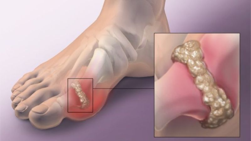 Nhờ luteolin trong kê có đặc tính giảm acid uric mà giúp hỗ trợ điều trị bệnh gout hiệu quả Nhờ luteolin trong kê có đặc tính giảm acid uric mà giúp hỗ trợ điều trị bệnh gout hiệu quả