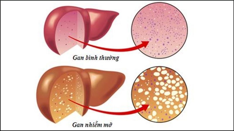 Gạo lứt đen có tiềm năng giảm nguy cơ mắc bệnh gan nhiễm mỡ không do rượu (NAFLD)