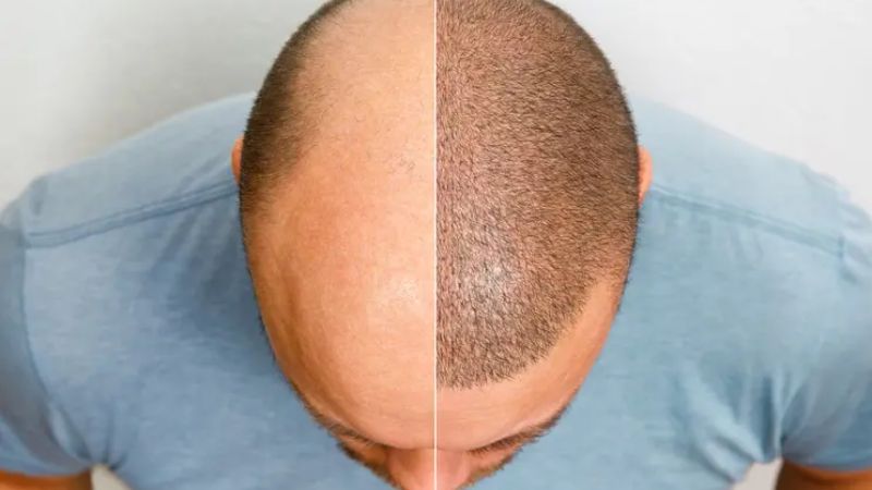 Acid azelaic được ứng dụng để trị hói ở nam giới