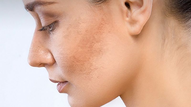 Kem acid azelaic 20% bôi 2 lần/ngày giúp làm giảm cường độ sắc tố và kích thước nám da