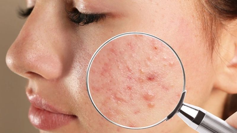 Acid azelaic giúp tiêu diệt vi khuẩn gây mụn và giảm viêm trên da