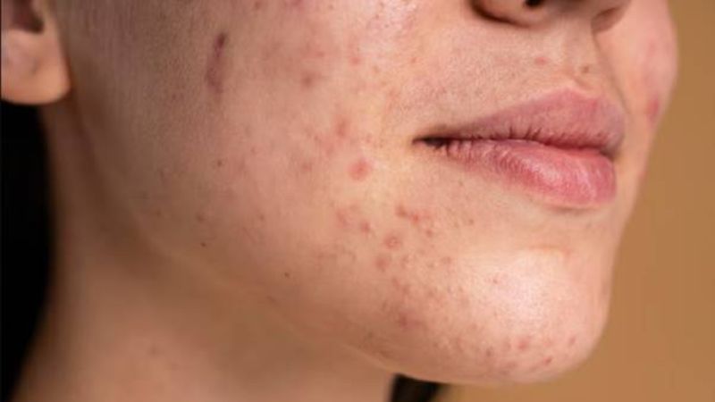 Acid azelaic thúc đẩy quá trình tái tạo tế bào mới, làm mờ sẹo và cải thiện tổn thương sau mụn