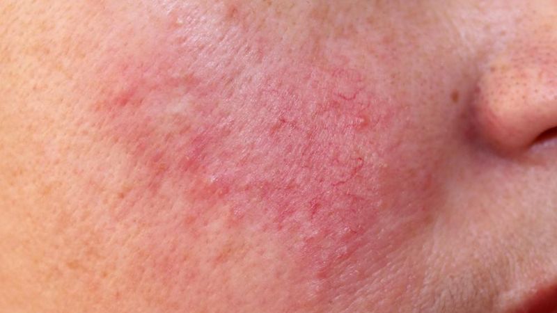 Acid azelaic giúp ngăn ngừa sự giãn nở của mạch máu, giảm đỏ mặt