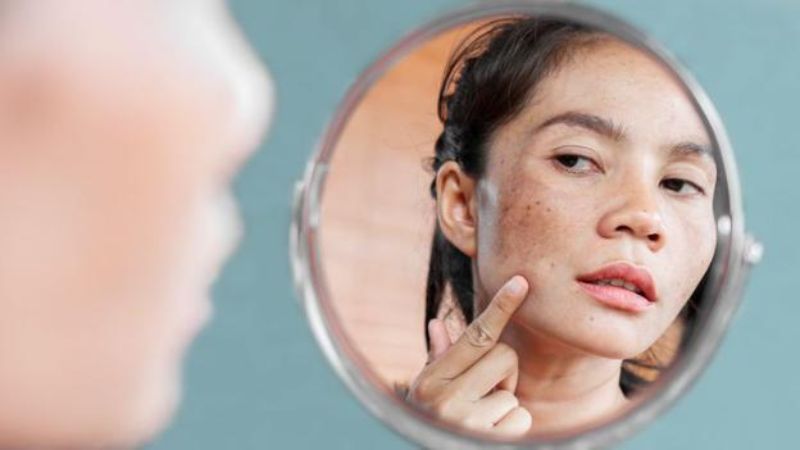 Acid azelaic ngăn chặn quá trình tạo ra sắc tố, giúp da sáng khỏe hơn