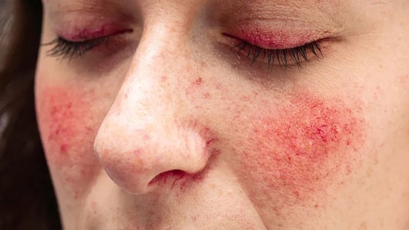 Acid azelaic là một phương pháp điều trị hiệu quả các triệu chứng của bệnh hồng ban